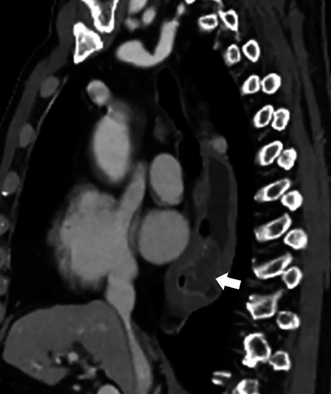 cad1em's tweet photo. 食道リンパ管腫esophageal lymphangioma

消化管発生は稀
これも見たことない

PMID 39234015
#RdiagTips https://t.co/P0bOsKDk3a