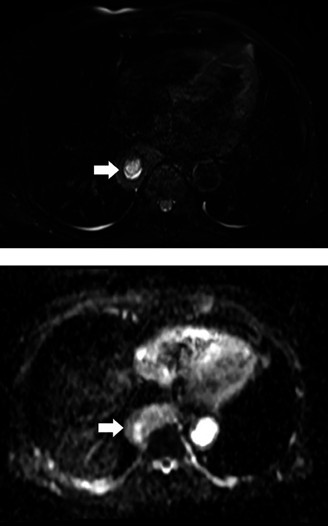 cad1em's tweet photo. 食道リンパ管腫esophageal lymphangioma

消化管発生は稀
これも見たことない

PMID 39234015
#RdiagTips https://t.co/P0bOsKDk3a