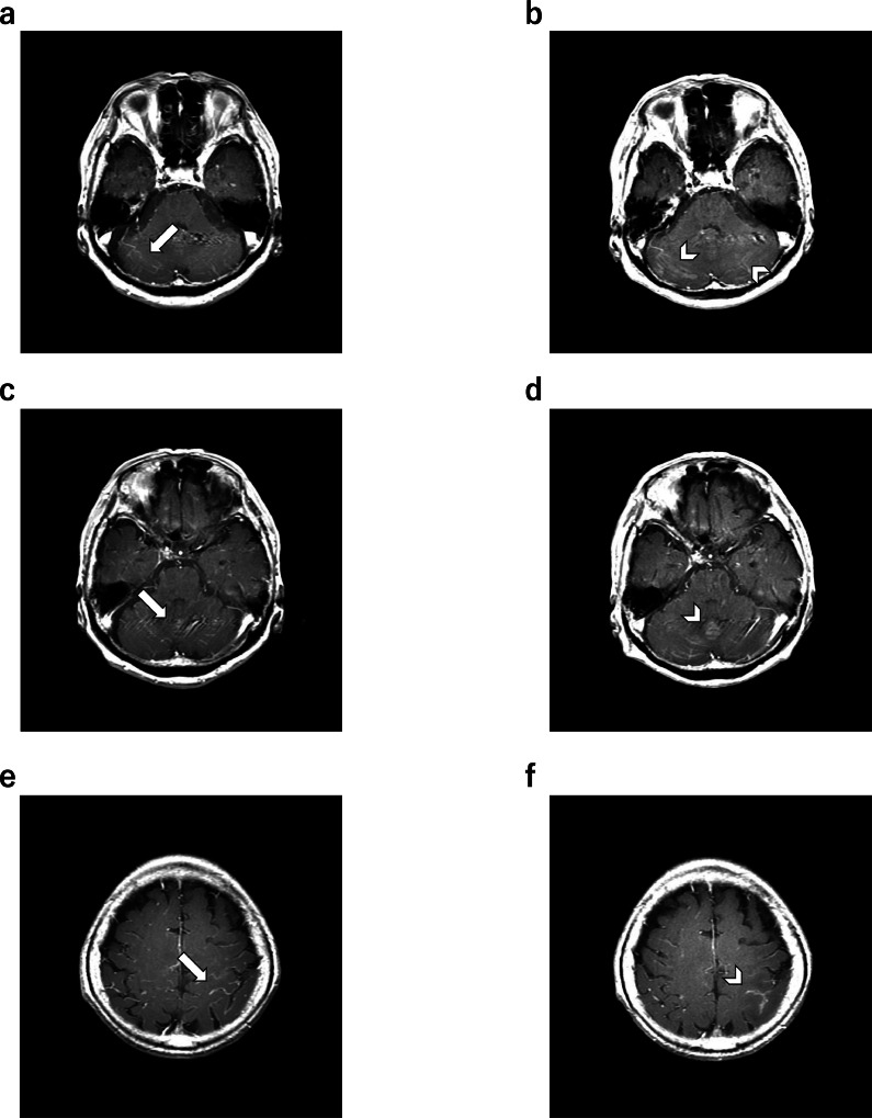 cad1em's tweet photo. クリプトコッカス髄膜炎cryptococcal meningitis

いい画像が見つからなかったけど、確かTbと同様に頭蓋底やシルビウス裂の頻度が高いのと、慢性髄膜炎で視床枕に石灰化が見られうる、はず

PMID 39296744
#RdiagTips https://t.co/fio6ICJ1nZ