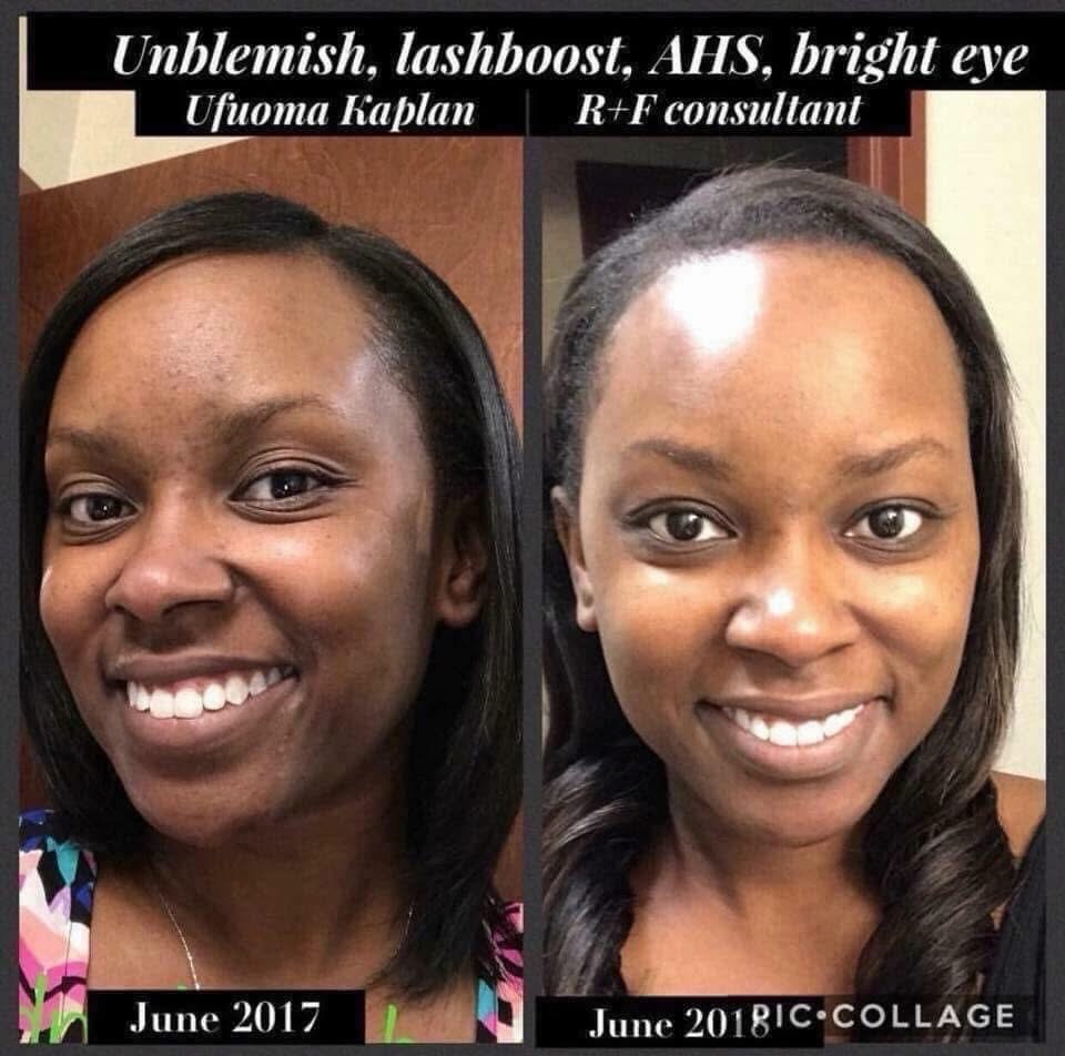 CyrusComeguooc's tweet photo. Check out Ufuoma’s Unblemish and AHS Bright Eye Complex Serum and Lash Boost results! With our 60-day money-back guarantee, there’s nothing to lose. Message me to get started today! https://t.co/P9mM3d5qeU