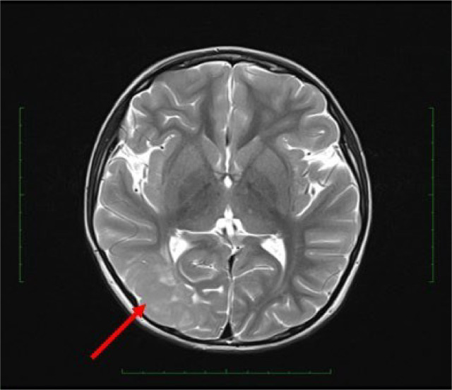 cad1em's tweet photo. ganglioglioma

5歳男児、難治性てんかん

PMID 39493940
#RdiagTips https://t.co/n8pX6KGq03