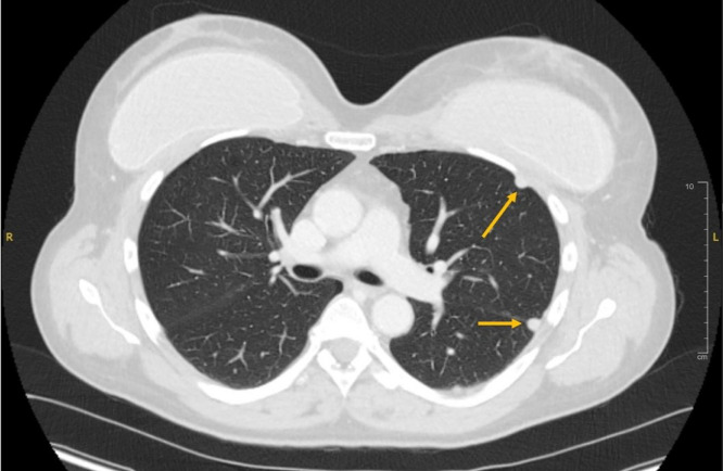 cad1em's tweet photo. silicone deposition

乳房インプラントrupture→リンパ路を介して胸膜上に結節、おそらくシリコン沈着という報告。組織はとってない。腋窩リンパ節はUSでシリコン沈着らしいsnowstorm appearance、らしい

おおきいやつ生検してほしいなぁ…

PMID 39507436
#RdiagTips https://t.co/P6GBhTkqzn