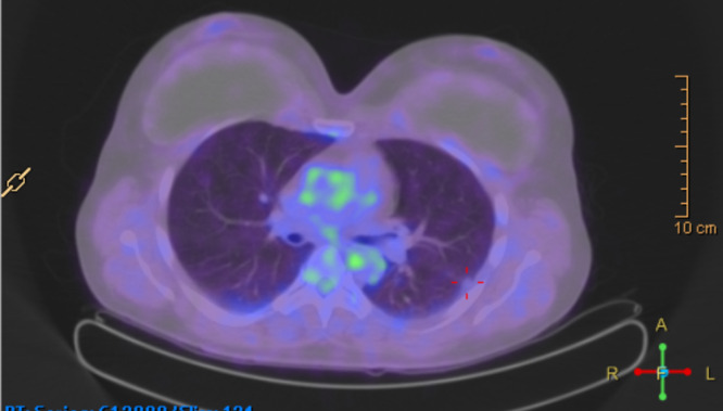 cad1em's tweet photo. silicone deposition

乳房インプラントrupture→リンパ路を介して胸膜上に結節、おそらくシリコン沈着という報告。組織はとってない。腋窩リンパ節はUSでシリコン沈着らしいsnowstorm appearance、らしい

おおきいやつ生検してほしいなぁ…

PMID 39507436
#RdiagTips https://t.co/P6GBhTkqzn