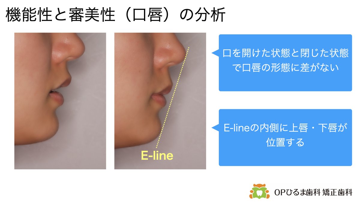Yasu_OP's tweet photo. 骨格性，歯槽性の分析に続いて機能性と審美性の分析を行います

機能性の分析とは

唇の閉じやすさ，舌の位置，顎関節内の下顎（頭）の位置や動きを主に評価します

さらに機能的に優れている顔貌は他者から美しいと感じられるので美しく機能的な審美性も分析します

機能的な審美性の高い口元のバランスは

側貌ではE-lineの内側に上唇下唇が位置していること

鼻から上唇にかけて緩やかなカーブがあること

下唇からおとがいにかけて緩やかなカーブがあること

上唇に対して下唇がわずかに後退していること

口唇閉鎖時と安静時（リラックスしてポカンと口を開けた状態）の口唇の形に差がないこと

などとなります

機能としては，舌と顎関節を評価します

舌の位置は，舌が大きすぎて歯を押し出したりしていないか，下顎歯列の上に舌が乗っかって噛み合わせを不安定にしていないかなどを分析します

顎関節は．関節窩の中で下顎（頭）が安定した位置にあるのか，その位置でしっかりと噛めているのかなどを評価します

#矯正歯科　#歯列矯正