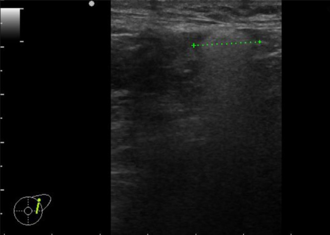 cad1em's tweet photo. silicone deposition

乳房インプラントrupture→リンパ路を介して胸膜上に結節、おそらくシリコン沈着という報告。組織はとってない。腋窩リンパ節はUSでシリコン沈着らしいsnowstorm appearance、らしい

おおきいやつ生検してほしいなぁ…

PMID 39507436
#RdiagTips https://t.co/P6GBhTkqzn