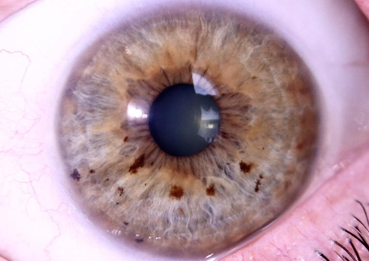 ClaudioGuipt5f's tweet photo. As an iridologist, I often see mixed iris patterns in clients who’ve had gallbladder removal. This may reflect a tendency toward liver and gallbladder stress—not a diagnosis. Support should be personalized to the whole person. https://t.co/S9kVHhZGKM