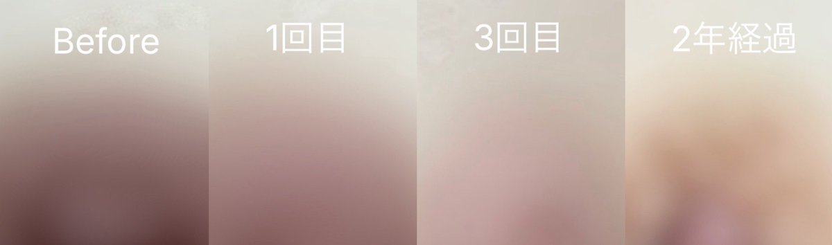 purin8013's tweet photo. フォーミー女性クリニック美白レーザーの2年経過レポです♫
いまだにこちらに関してDMを頂くので、まとめました（RP歓迎）

2枚目の画像のチャートにあるように、メラケアやアートメイクの「鮮やかさ」がアップする不自然な仕上がりが嫌いでした。
フォーミーの施術では「明るさ」がアップするので、とても自然。
2年経過して、少しだけ戻ったかもしれませんが、以前の暗黒乳首ではなく自信が持てるようになりました！
めちゃくちゃやって良かった✨