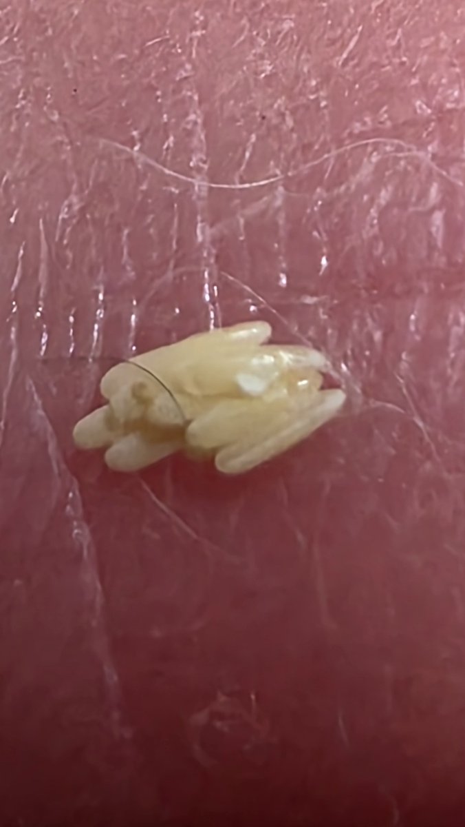 Natuuri98's tweet photo. 閲覧注意です
今、子猫の体に付いてる卵
何かわかる方いますか？
お世話係も初めての経験です。
感染しないか？
孵化したら何になるの💦😭💦 https://t.co/iyo8BR6tjj