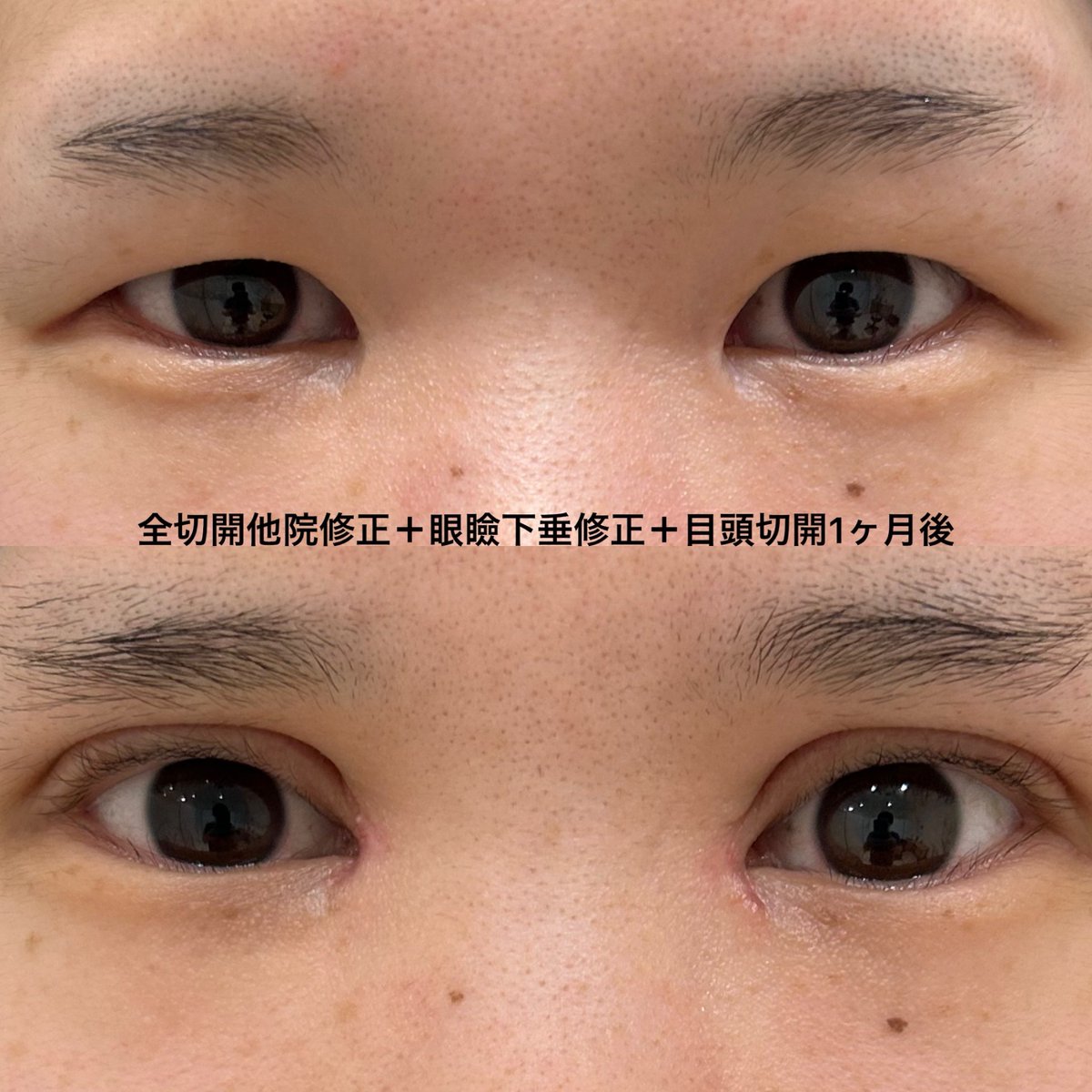 eternalprince08's tweet photo. 二重切開症例

過去に二重切開を受けられたものの緩んでほぼ一重瞼に戻ってしまっておりました

なるべく幅が広く、食い込みの深い平行二重をご希望されており、修正手術を行いました

#エターナルクリニック
#二重切開 https://t.co/RwLIxOcMzD