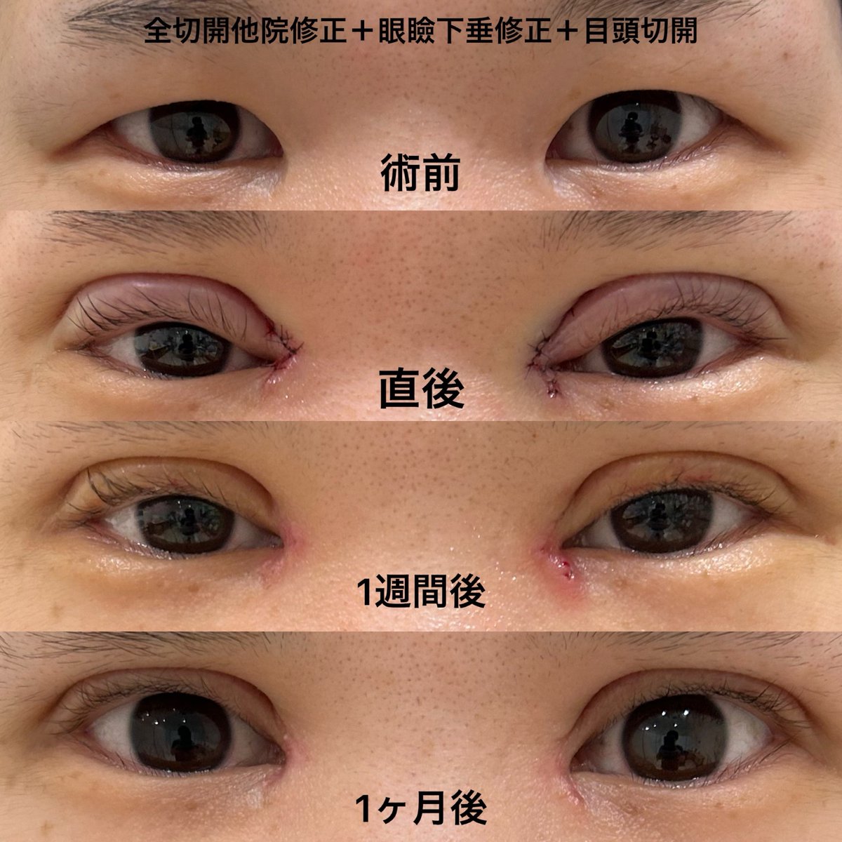 eternalprince08's tweet photo. 二重切開症例

過去に二重切開を受けられたものの緩んでほぼ一重瞼に戻ってしまっておりました

なるべく幅が広く、食い込みの深い平行二重をご希望されており、修正手術を行いました

#エターナルクリニック
#二重切開 https://t.co/RwLIxOcMzD