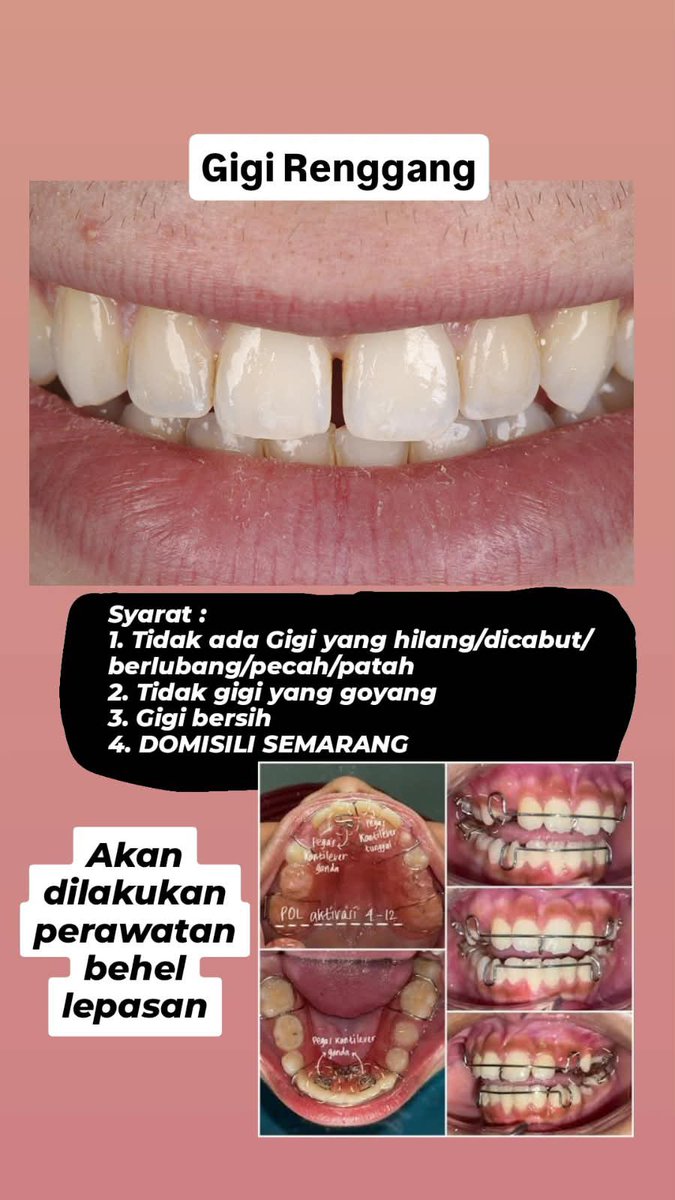 rapsbrie's tweet photo. hai hai 👋🏻

Perkenalkan, aku Koas Gigi yang lagi cari pasien dengan keluhan gigi dan mulut seperti di gambar

📍: RSGM Unimus
🗓️: Senin–Jumat | 09.00–16.00  

Yang berminat, boleh langsung hit me up yaaa!
 #koasgigi #koasgigiSemarang #pasienkoas #caripasien https://t.co/l1zQji5wmG