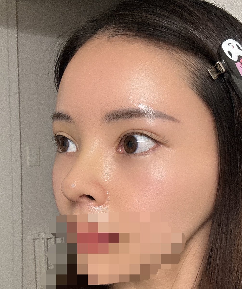 miyubebexx's tweet photo. 鼻フル再手術DT8日目👃
ギプス除去+鼻柱の抜糸してきた🪡
触ったら痛いしまだ腫れてるけどすでに良すぎる🥹！鼻柱～鼻尖かわいい、、
ここから腫れも引いて馴染んでいくの楽しみ(ˊo̴̶̷̤ ̫ o̴̶̷̤ˋ) https://t.co/6zAV7k7PzV