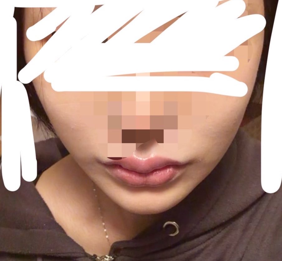 Eemmiii_io's tweet photo. 15日目！
まだ突っ張ってる感は強い！
なんか口角も上がってて嬉しい(；；
引越しのダンボール多すぎるから汚い https://t.co/n79yjismjC