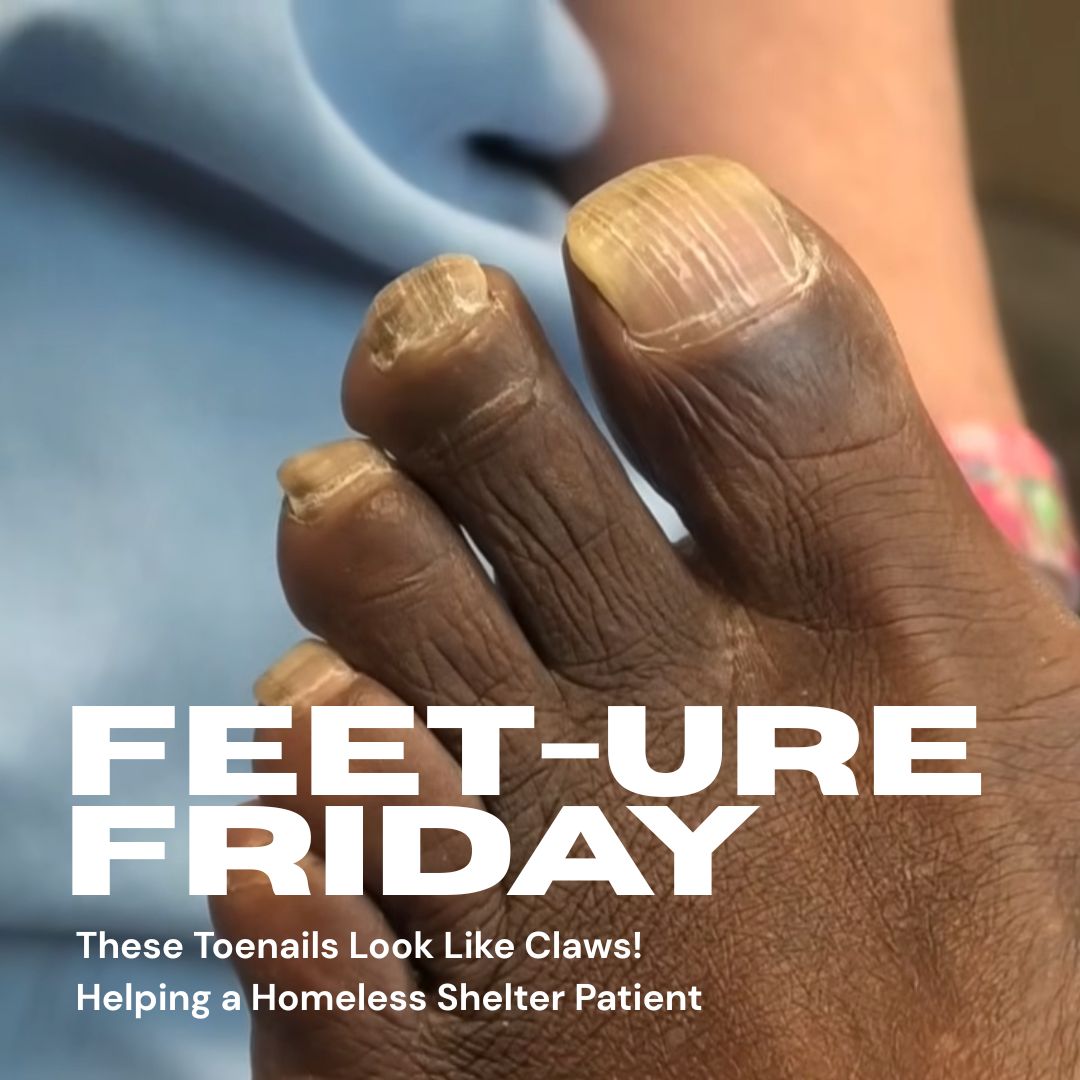 drnailnipper's tweet photo. FEET-ure Friday today at 4:00pm ET

These Toenails Look Like Claws! Helping a Homeless Shelter Patient - https://t.co/o6KByaqLDJ

@MiamiRadioBeast @PodiatryToday @PodiatryMidwest https://t.co/3xGBVXBZQ1