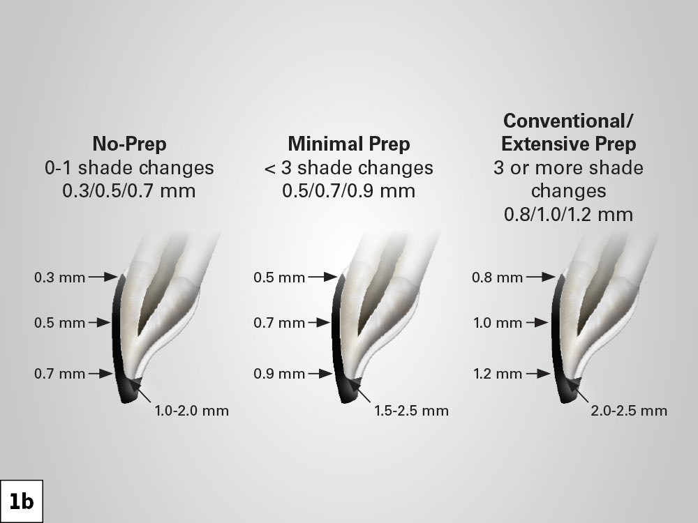 DrHamza001's tweet photo. Im conventional teeth preparation we know for sure that the optimum incisal reduction is 1-1.5mm.
But that does not always mean you should prep as much as you can.
Because in most cases the aim of veneers is just to lap the incisal edge. https://t.co/wgJD1jEiF8
