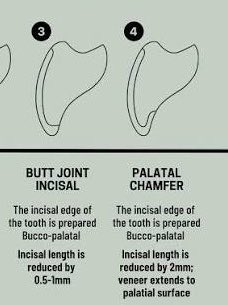 DrHamza001's tweet photo. Studies showed that butt joint is more preferred over the palatal chamfer and has more survival rate. https://t.co/ZOFMyynDkU