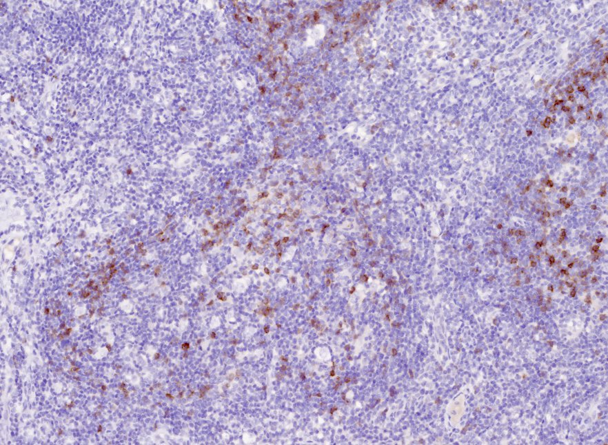 Tiger_heme's tweet photo. Easy case, for trainees. Make a diagnosis without H&amp;E 🙃 IgD, CD21, OCT2, MEF2B. Did you get it right? Check the comments https://t.co/nYavnxzfL3