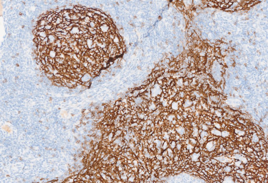 Tiger_heme's tweet photo. Easy case, for trainees. Make a diagnosis without H&amp;E 🙃 IgD, CD21, OCT2, MEF2B. Did you get it right? Check the comments https://t.co/nYavnxzfL3