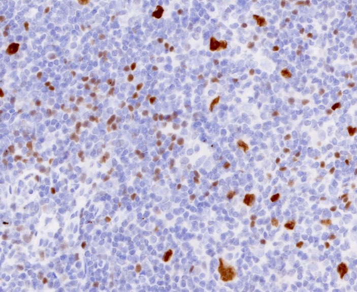 Tiger_heme's tweet photo. Easy case, for trainees. Make a diagnosis without H&amp;E 🙃 IgD, CD21, OCT2, MEF2B. Did you get it right? Check the comments https://t.co/nYavnxzfL3