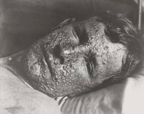 DrNeilStone's tweet photo. Natural immunity" to smallpox was available for centuries. 

The 30% death rate was the problem. https://t.co/rRBM3sytVt