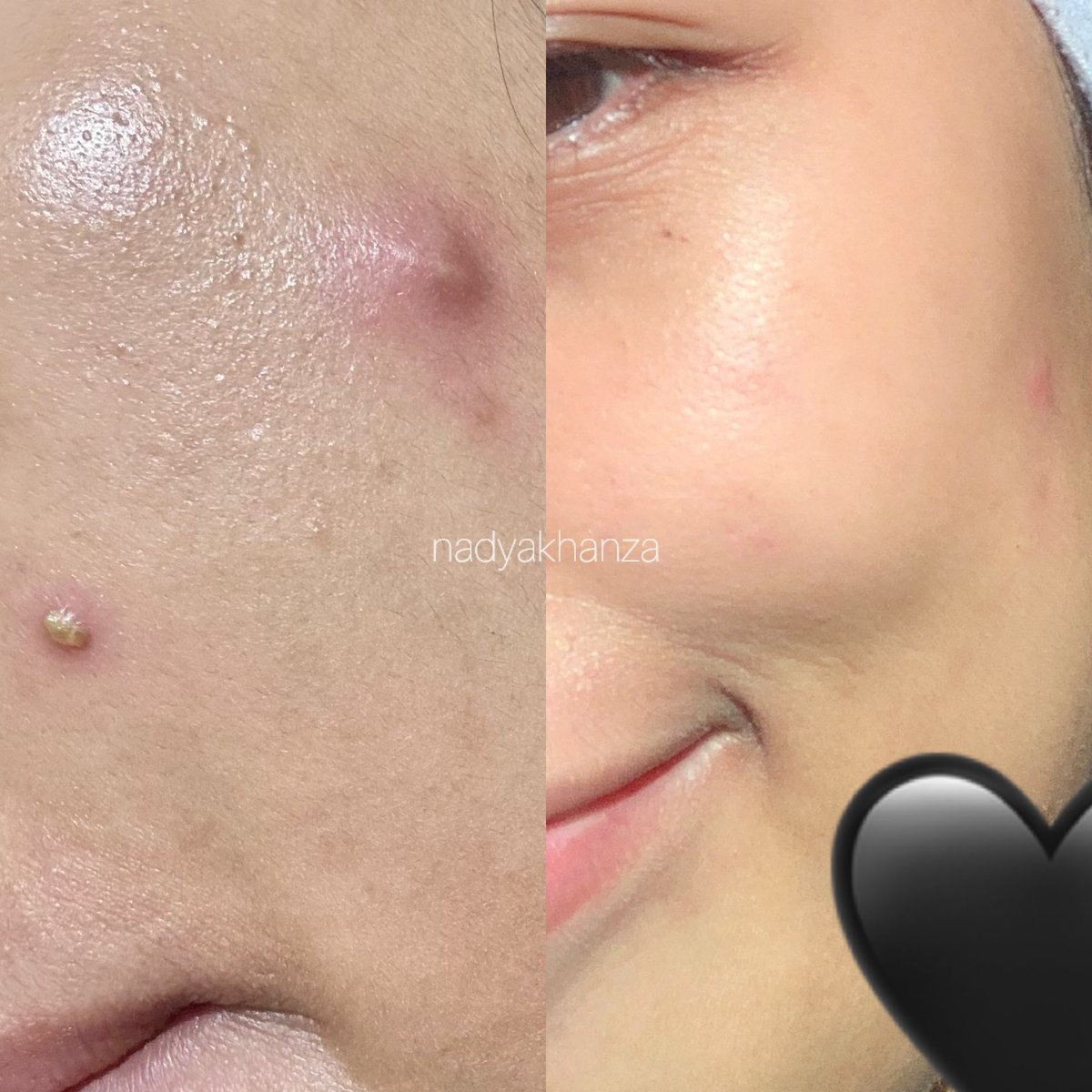nadyakhanza's tweet photo. for REAAALLL!!! ini serum acne yang gue akui cepet banget bikin mateng jerawat tapi cepet juga kempesnya gak ada SEMINGGU😭🙏🏻 https://t.co/AFscg3hmtn