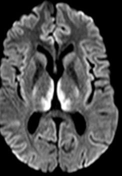 DrAyubaD's tweet photo. Confusion, nystagmus, ataxia. Post-bypass. MRI: medial thalami + periaqueductal grey light up. 
What is the diagnosis ? Image credit ; Radiopedia #MedX https://t.co/Vk4x8yPqu3