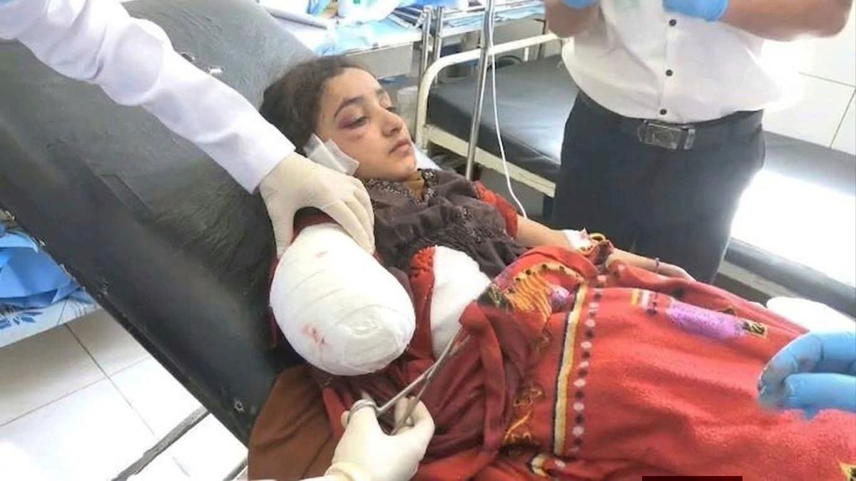 da377p's tweet photo. طفلة صغيرة
بترت يدها وأثخن جسدها بالشظايا، 
إثر سقوط صاروخ سعودي بجوار منزلها في مديرية رازح محافظة صعدة.. 
جرائم العدو السعودي في اليمن# https://t.co/GFfMJL0zIJ