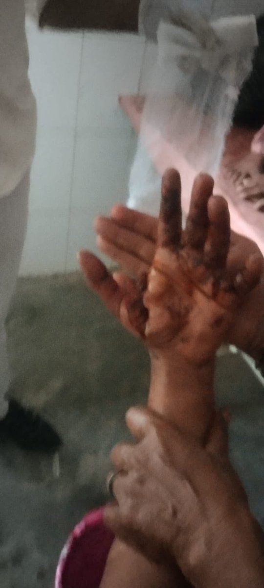 UP51BASTI's tweet photo. #बस्ती धारदार हथियार से हमला हाथ कटे, हाथ पैर टूटा सिर फटा हत्या के प्रयास का गौर पुलिस नहीं दर्ज कर रही मुकदमा 24 की घटना आज भी नहीं दर्ज हुआ मुकदमा पुलिस करने का कर रही इंतजार तब लिखेगी मुकदमा। @Uppolice @bastipolice @digbasti @AdgGkr @dgpup @myogiadityanath @myogioffice https://t.co/fn1G45qcvZ