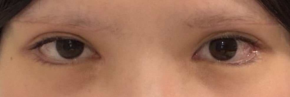 melolynun's tweet photo. 眉下切開DT11日目

まだ傷ボコついてるし触ったら痛いしメイクしても目頭側は隠しにくい😞けど瞼の重い感じは無くなって嬉しい♩
あと目左右非対称すぎる 左もうちょい開きよくならないかな https://t.co/cI4ZWMUquN