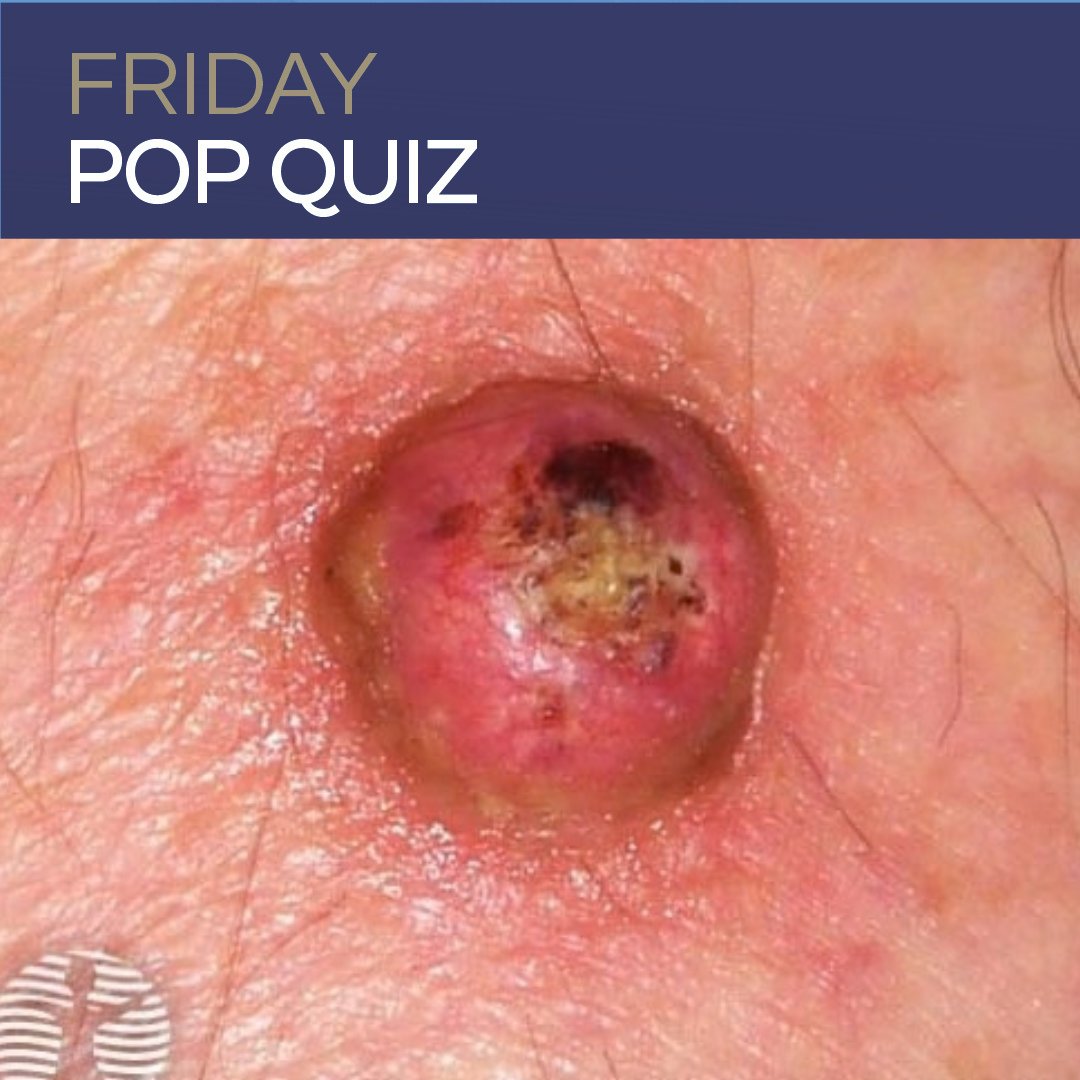 DermInReview's tweet photo. A new Friday Pop Quiz is live! Can you guess the correct answer to this board review-style question?

Drop your best guess in the comments below!

Then, head over to Next Steps in Derm to check the correct answer and read the full explanation breakdown: https://t.co/HeyRPoxp9X https://t.co/1m9YSN240P