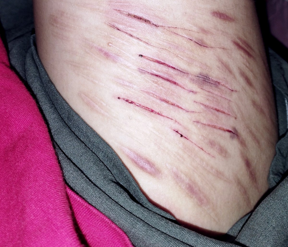 evedumpp's tweet photo. Styro styro styor atyor styro styeo

Does this count as studying integumentary system? 
I've reached the reticular layer yes yes 🙂‍↕️ https://t.co/1Z2p3LK2fu