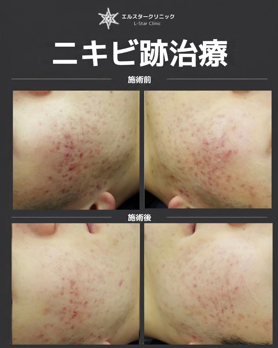 skinmaster0308's tweet photo. 【両頬のニキビの赤みにお悩みの患者様、レーザー治療３回での改善症例】  

「ニキビが引いた後も残る赤い跡が消えず、大きなストレスを感じていました」  

今回ご来院されたのは、両頬全体に広がったニキビの赤みでお悩みの患者様です。

ニキビ自体の炎症が落ち着いた後も、皮膚の表面や深部に赤みがそのまま残ってしまうと、お肌全体が荒れて見えてしまい、大きな悩みとなります。  

当院にて３回のレーザー施術を行っていただいたところ、非常に素晴らしい改善が見られました。  

[施術前の状態]

左右の頬全体に濃いニキビの赤みが広範囲に存在し、お肌のトーンが不均一に見える状態でした。  

[３回の治療後の変化]

施術を重ねるごとに赤みが急速に引いていき、目覚ましい効果が得られました。  

 赤みの減少とトーンアップ：左右どちらの頬も、治療前に比べて赤い跡が大幅に薄くなり、お肌全体のトーンが均一に整った  
 素早い経過：回数を重ねるごとに着実な変化が見られ、わずか３回の施術で素早い改善を実現
  
[治療のポイント]

ニキビの赤み（色素沈着や血管の拡張）は、放置しても自然には消えにくく、正しいアプローチを行うことが重要です。  

患者様お一人おひとりの肌状態に合わせた適切なレーザー施術を行うことで、短期間でも安全かつ効果的に肌の赤みを改善することができます。  

繰り返すニキビの跡や赤みでお悩みの方も、ぜひ諦めずに当院までご相談ください。 

#ニキビの赤み #ニキビ跡 #色素沈着 #肌質改善 #皮膚再生 #韓国整形 #渡韓整形 #美肌治療 #韓国美肌 #トーンアップ #肌再生 #韓国美容 #美容皮膚科 #赤ら顔改善
#エルスタークリニック