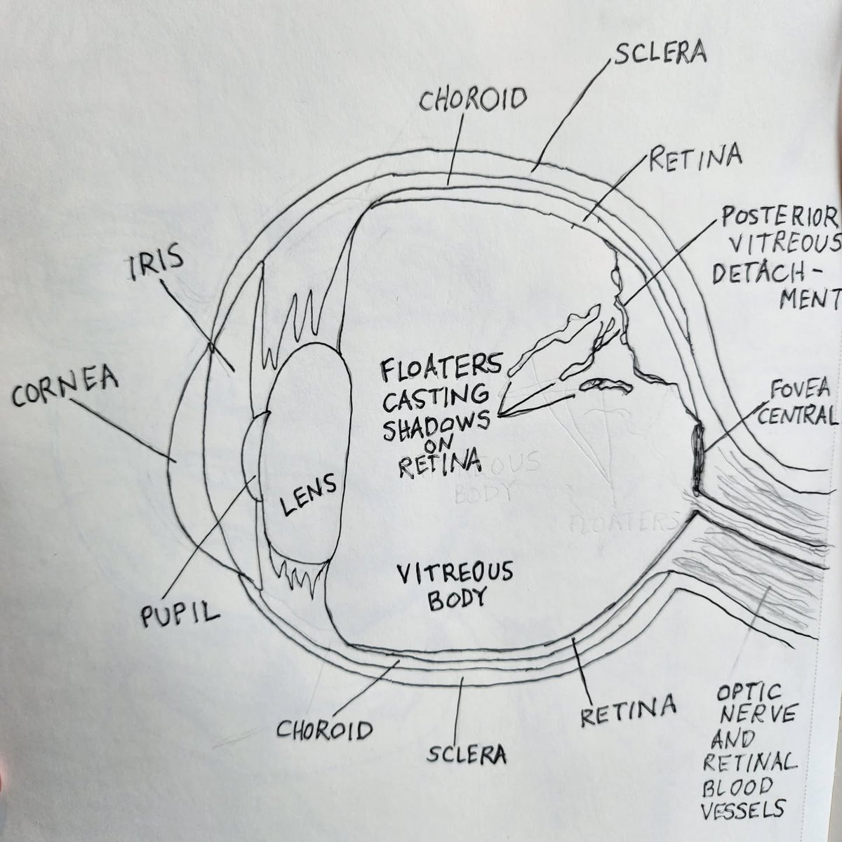 OscarMosty's tweet photo. Day 2731: I researched eye anatomy to better understand the link between posterior vitreous detachment and retinal detachment, then drew what I learned. Thankfully, they didn’t occur together. My risk is higher for a few months, but still low. https://t.co/oAveYeI8sW