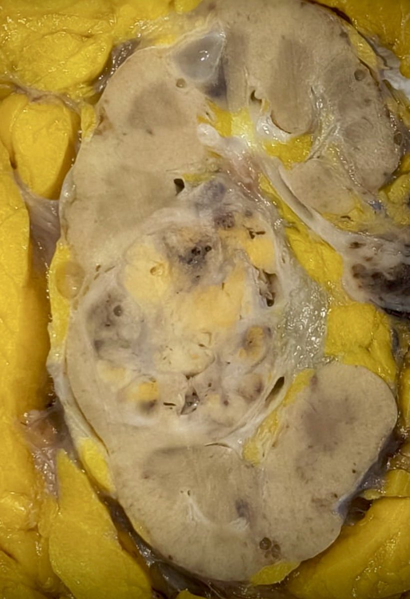 vintage81106614's tweet photo. The art of grossing. A 64 yo woman with gross hematuria. Left Radical Nephrectomy. 6.4x5cm tumor. Final Dx. Conventional Clear Cell RCC, grade 2, WHO/ISUP. #pathologists #pathresidents #PathTweeter #GUpath @SLAPpatologia https://t.co/Lu4LIEaywV