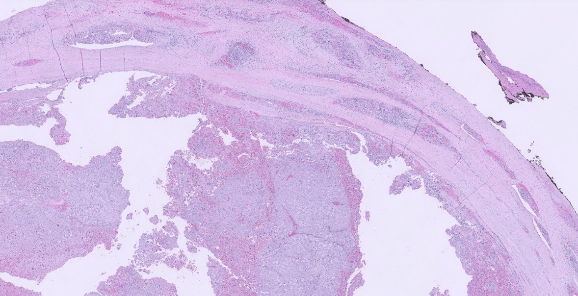 PeterKobalka's tweet photo. Surgical is back! Poorly differentiated carcinoma. Widespread capsule invasion as well as LVI. My colleague says has Oncocytic features, no features of PTC. #ENTpath #HeadandNeckPath #HeadNeckPathol https://t.co/rVXVxx3w7w