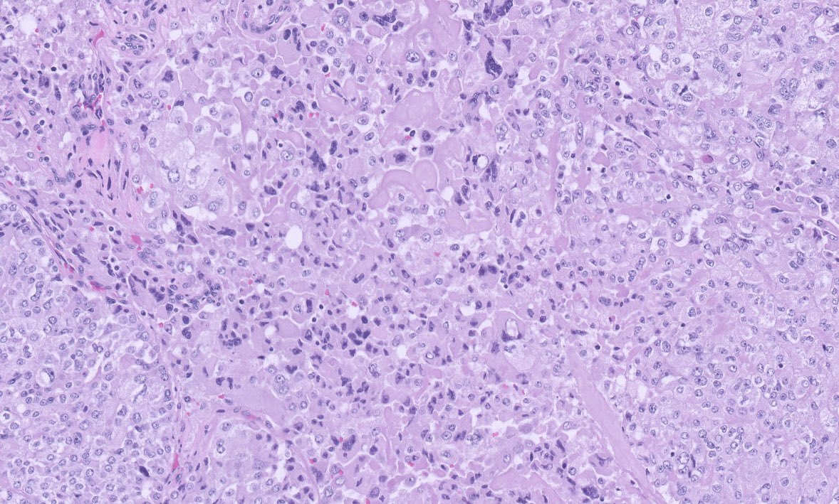 PeterKobalka's tweet photo. Surgical is back! Poorly differentiated carcinoma. Widespread capsule invasion as well as LVI. My colleague says has Oncocytic features, no features of PTC. #ENTpath #HeadandNeckPath #HeadNeckPathol https://t.co/rVXVxx3w7w