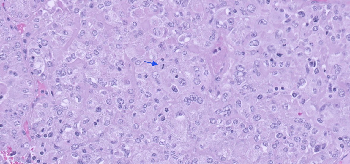 PeterKobalka's tweet photo. Surgical is back! Poorly differentiated carcinoma. Widespread capsule invasion as well as LVI. My colleague says has Oncocytic features, no features of PTC. #ENTpath #HeadandNeckPath #HeadNeckPathol https://t.co/rVXVxx3w7w