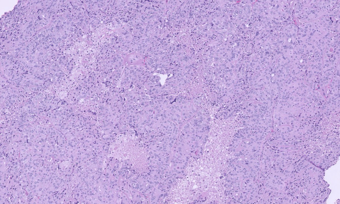 PeterKobalka's tweet photo. Surgical is back! Poorly differentiated carcinoma. Widespread capsule invasion as well as LVI. My colleague says has Oncocytic features, no features of PTC. #ENTpath #HeadandNeckPath #HeadNeckPathol https://t.co/rVXVxx3w7w