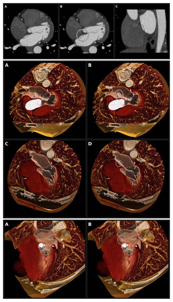 DeBakeyCVedu's tweet photo. See the Multimodality Museum Image in our new issue! 

“Cinematic Rendering of a Fenestrated Patent Foramen Ovale Within a Left-Sided Atrial Septal Pouch" by Drs. Amy Avakian &amp; Muhammad Umair

https://t.co/InneUx2qAY
#DeBakeyCVJournal 
@maquinonesmd @NadeenFaza #FenestratedPFO https://t.co/wbR69ppLmD