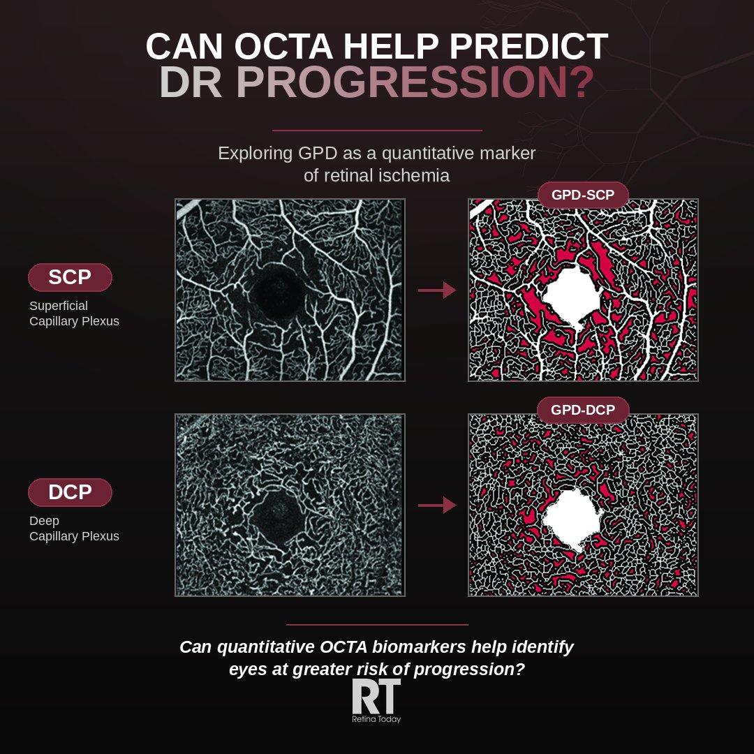 RetinaToday's tweet photo. Can OCTA predict DR progression? Kallista Zhuang, BA, Shinji Kakihara, MD, PhD, and Amani A. Fawzi, MD review the evidence in Retina Today's Sept issue. Read: https://t.co/1lXd43nNA9  #RetinaResearch #Ophthalmology https://t.co/9siwQWbreB