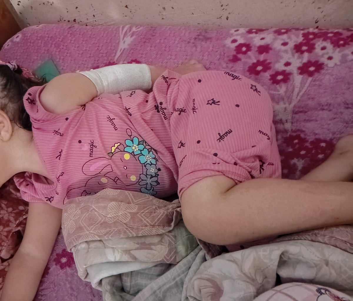 khlwd57603's tweet photo. More than 11,000 children in Gaza have suffered such injuries and need long-term support. Please, Hala still needs three difficult surgeries.
Please don't stop supporting us; we need all the help you can get. 
https://t.co/WOmGFuOAHt https://t.co/YSAhaADjAE