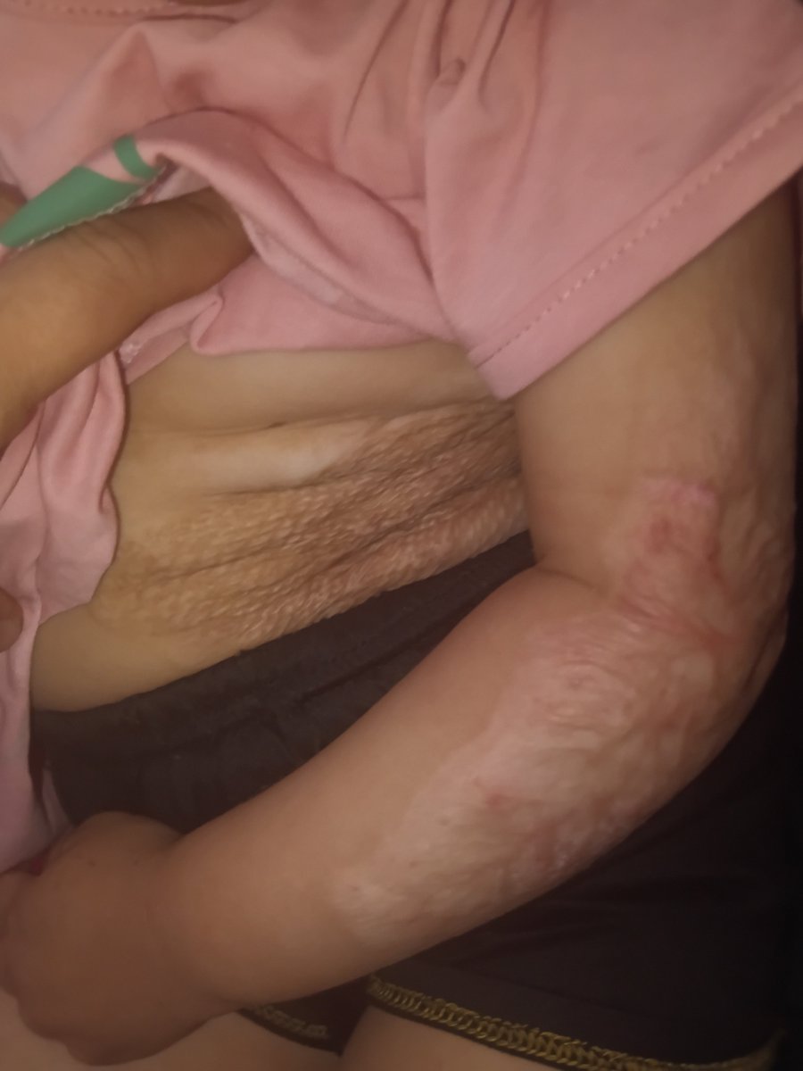 khlwd57603's tweet photo. More than 11,000 children in Gaza have suffered such injuries and need long-term support. Please, Hala still needs three difficult surgeries.
Please don't stop supporting us; we need all the help you can get. 
https://t.co/WOmGFuOAHt https://t.co/YSAhaADjAE