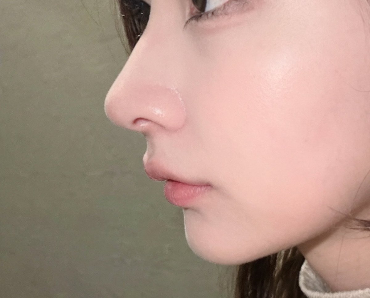唇が内側に巻き込んでるから薄く見えると思うんだけど人中短縮しかないんかな❓ヒアルで改善しますか…それかCカール形成❓ https://t.co/5gkwZ5Wytc
