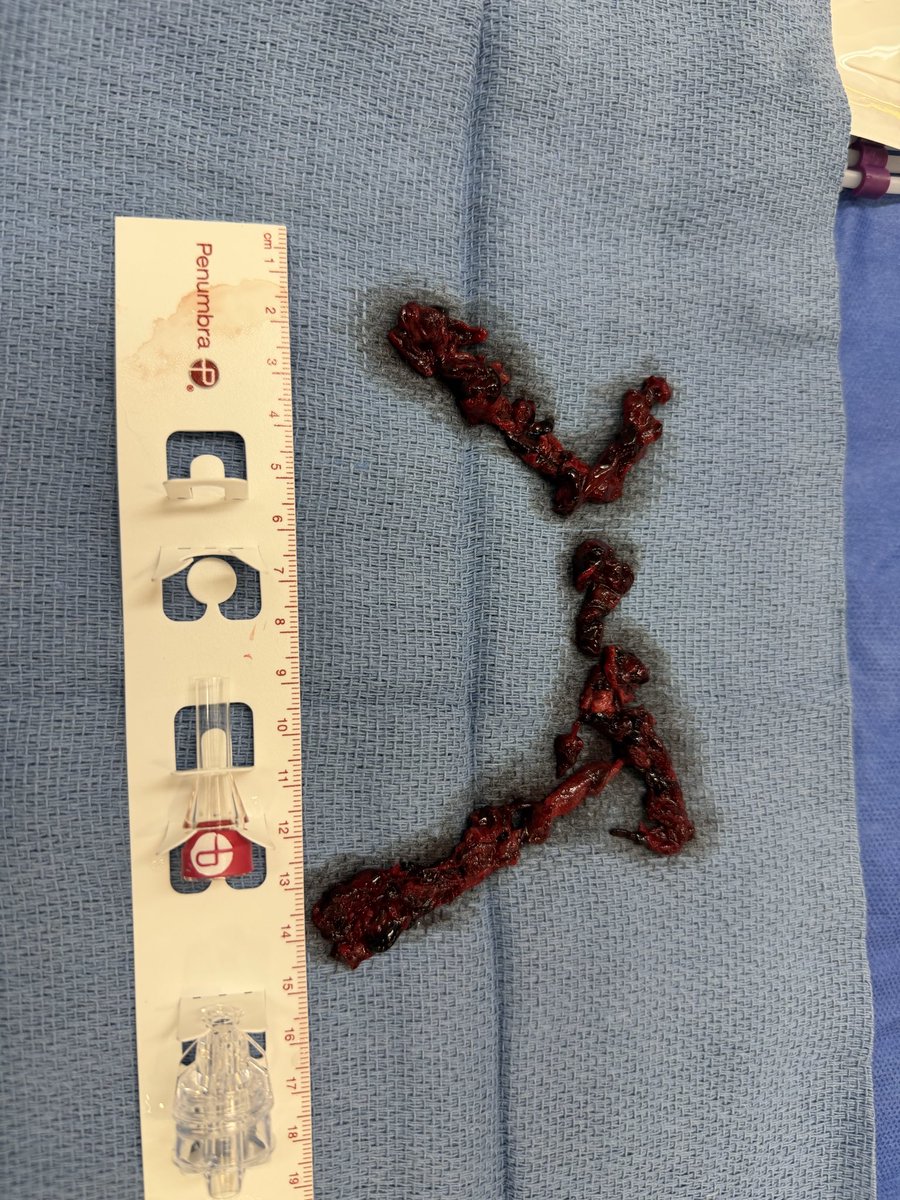 trinius33's tweet photo. @Jason Not getting paid enough for doing lifesaving procedures to extract clot for pulmonary embolism (#3 killer) in the middle of the night 

#healthcare #medicine #penumbra #pulmonaryembolism https://t.co/uPLhGFP4Sn