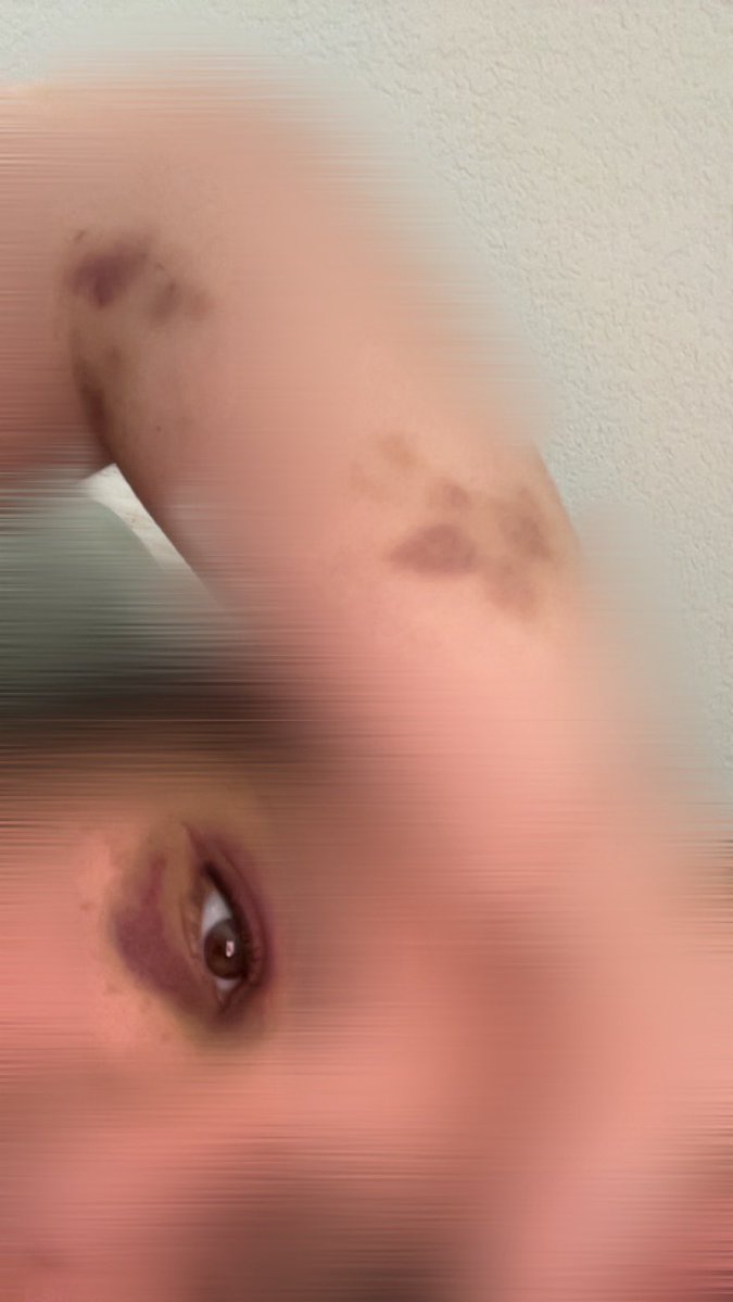 Knz_ab's tweet photo. 4/Des coups dans la tête, des coups de pied sur toutes les parties de mon corps. J’ai eu un traumatisme crânien, le nez cassé, des blessures au crâne et des saignements importants. J’essayais d’ouvrir les yeux, mais à chaque fois que je levais la tête, un nouveau coup arrivait. https://t.co/cYlhZNG269