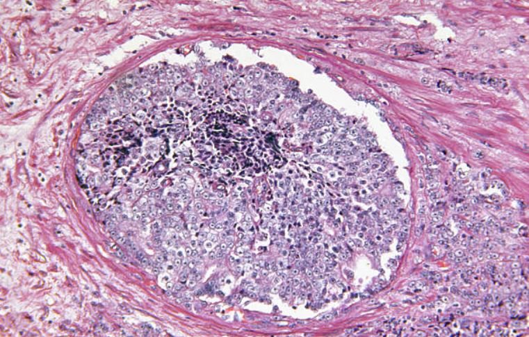 ProstateCell's tweet photo. Restoring DPP4 expression via capsaicin suppresses prostate tumorigenesis in castration-resistant prostate cancer (CRPC) models, suggesting DPP4 could be a new target for CRPC.

Read the study: https://t.co/QdpZgsKJ29

Led by first author José María Mora-Rodríguez and corresponding author Inés Díaz-Laviada at the University of Alcalá and IDISCAM.

#ProstateCancer #Oncology #DrugDiscovery