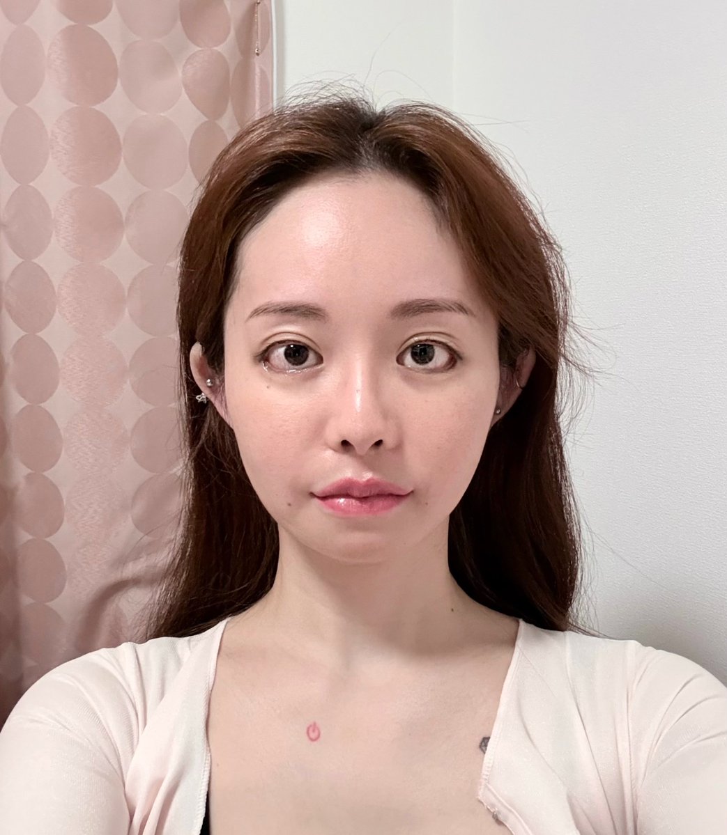 こんな時間なんでやばい無加工投下。
iPhone無加工すっぴんカラコンなし。

遠心顔感がすごいけど、メイクするとかなり良い感じになるので本当にやってよかったです。
三白眼はもうなってるしどうでもいいのでとにかくデカくしてってオーダーした。
目の下のホクロよりも外側に広がった。 https://t.co/26Wk9ax7AM