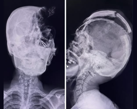 estherzelda0514's tweet photo. This is so fake. Here's what a real fatal gunshot to the head by a high velocity round looks like in an x-ray. The force of the bullet destroys much of the skull and facial bones, leaving behind multiple fractures and large areas where bone structure is completely gone. Bone and metal are seen throughout the head, showing how the bullet shatters on impact and spreads debris through brain tissue. A gunshot to the head doesn’t cause localized drama, the shockwave from the impact damages internal cranial structures, causing death.

This is what you would expect to see from a "sniper shot to the head" if such a thing were happening in Palestine. It is not. The x-ray he offers is literally just a bullet placed over someone's face.