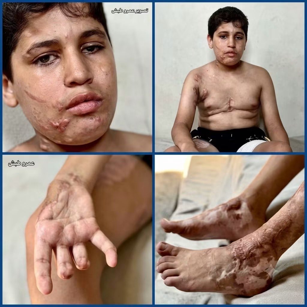 AhmedAAshour8's tweet photo. I want to see my mother’s face 💔

“I just want to see again and live like other children” This is the wish of Ibrahim Abu Shabab, a child from Gaza who lost his sight and suffered devastating injuries to his face, hands, and feet as a result of Israeli attacks. He also lost three of his fingers

Ibrahim did not just lose his eyes  he lost a childhood he had the right to live

Israel is still committing genocide in Gaza