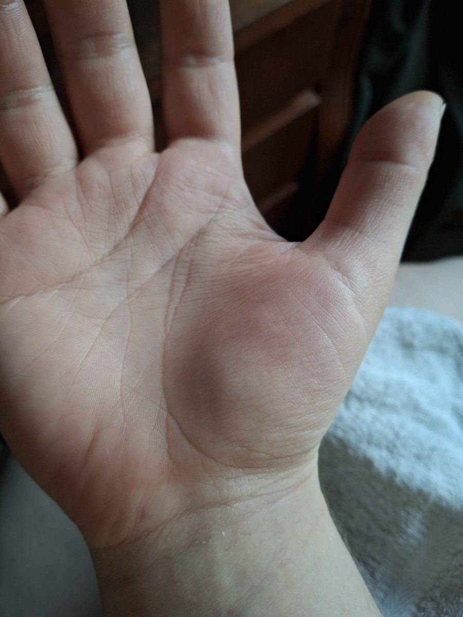iahevy's tweet photo. "non mais madame vous avez rien" 
ça me rend folle, genre j'invente des douleurs?? l'état de ma main je sais plus quoi faire https://t.co/CS86WbiK6f